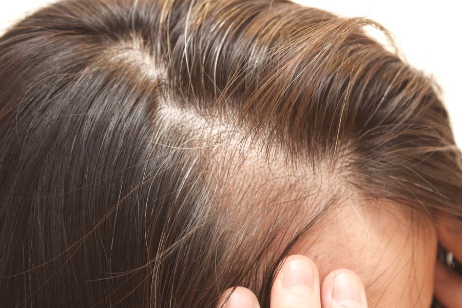 Hair Loss Treatment